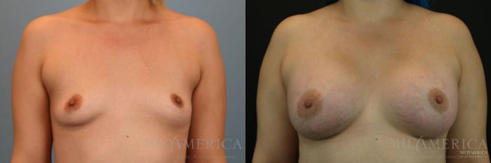 Before & After Breast Augmentation Case 129 View #1 View in St. Louis, MO