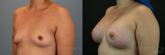 Before & After Breast Augmentation Case 129 View #2 View in St. Louis, MO