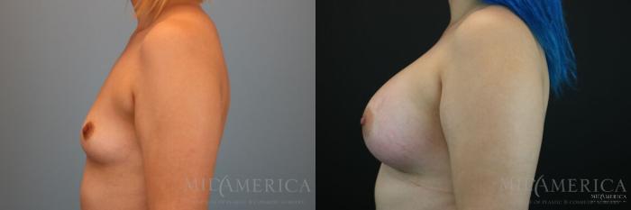 Before & After Breast Augmentation Case 129 View #3 View in St. Louis, MO