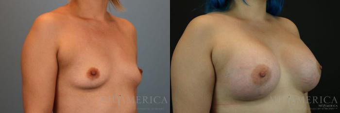 Before & After Breast Augmentation Case 129 View #4 View in St. Louis, MO