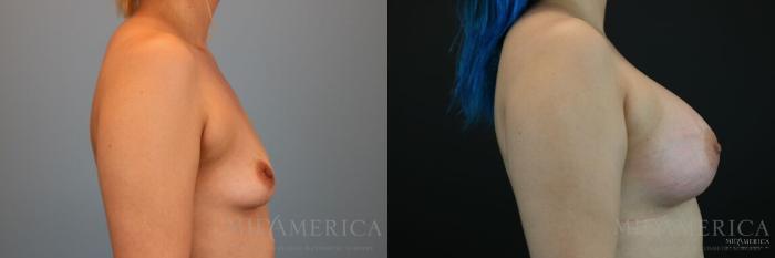 Before & After Breast Augmentation Case 129 View #5 View in St. Louis, MO