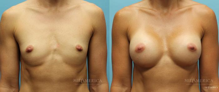 Before & After Breast Augmentation Case 13 View #1 View in St. Louis, MO