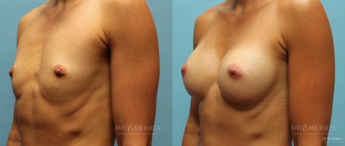 Before & After Breast Augmentation Case 13 View #2 View in St. Louis, MO