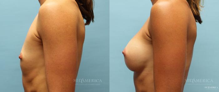 Before & After Breast Augmentation Case 13 View #3 View in St. Louis, MO