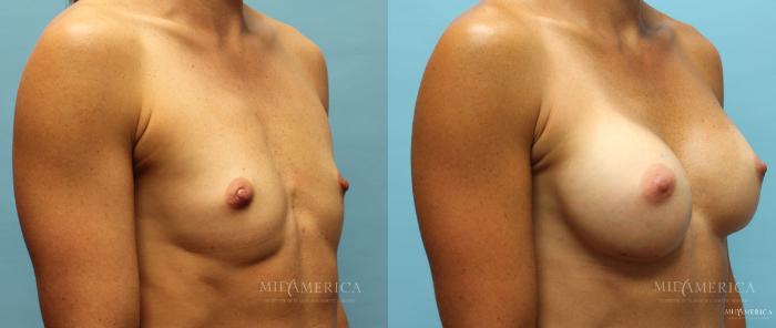 Before & After Breast Augmentation Case 13 View #4 View in St. Louis, MO