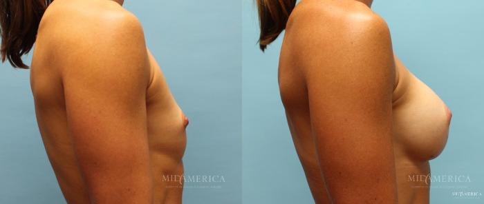 Before & After Breast Augmentation Case 13 View #5 View in St. Louis, MO