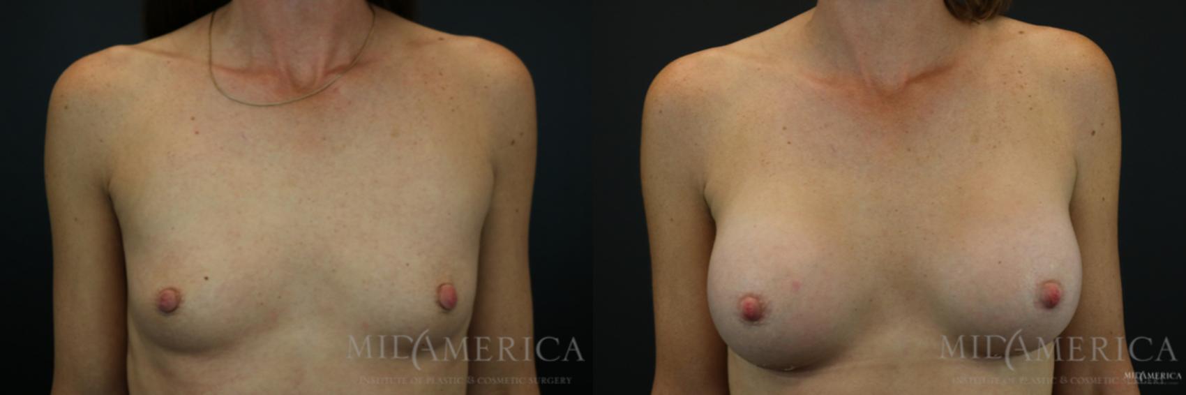 Before & After Breast Augmentation Case 135 View #1 View in Glen Carbon, IL