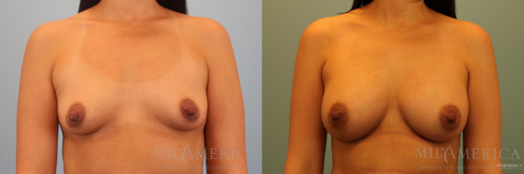 Before & After Breast Augmentation Case 137 View #1 View in Glen Carbon, IL