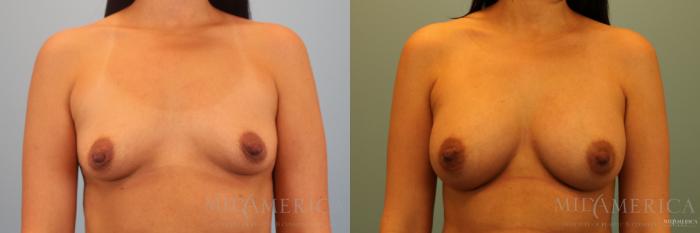 Before & After Breast Augmentation Case 137 View #1 View in St. Louis, MO