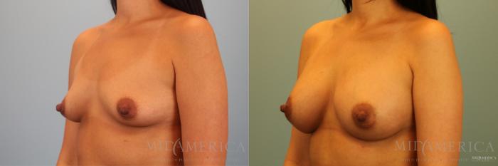 Before & After Breast Augmentation Case 137 View #2 View in St. Louis, MO