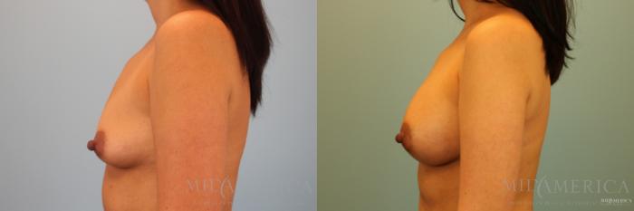 Before & After Breast Augmentation Case 137 View #3 View in St. Louis, MO