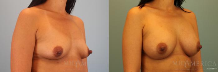 Before & After Breast Augmentation Case 137 View #4 View in St. Louis, MO