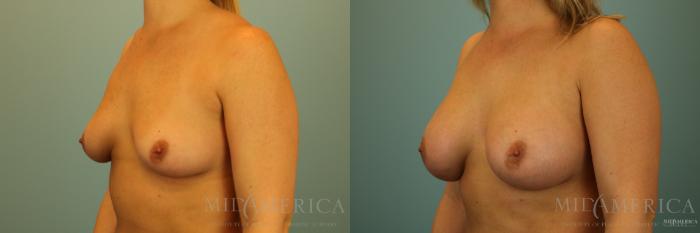 Before & After Breast Augmentation Case 139 View #2 View in Glen Carbon, IL