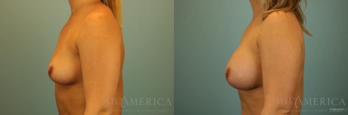 Before & After Breast Augmentation Case 139 View #3 View in Glen Carbon, IL