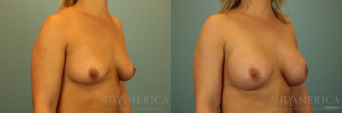 Before & After Breast Augmentation Case 139 View #4 View in Glen Carbon, IL