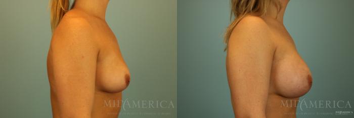 Before & After Breast Augmentation Case 139 View #5 View in Glen Carbon, IL