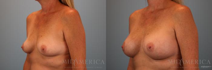Before & After Breast Augmentation Case 140 View #2 View in St. Louis, MO