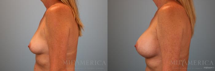 Before & After Breast Augmentation Case 140 View #3 View in St. Louis, MO