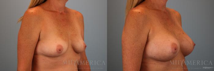 Before & After Breast Augmentation Case 140 View #4 View in St. Louis, MO
