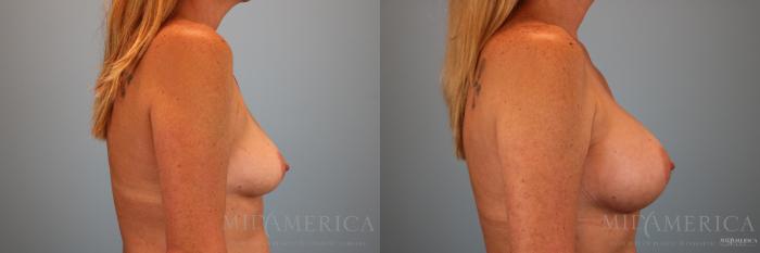 Before & After Breast Augmentation Case 140 View #5 View in St. Louis, MO
