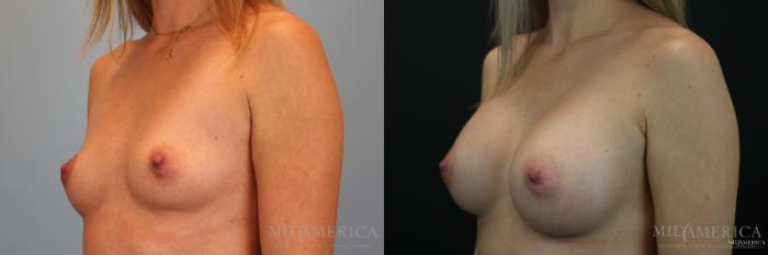 Before & After Breast Augmentation Case 152 View #2 View in Glen Carbon, IL