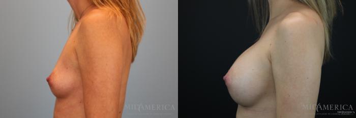 Before & After Breast Augmentation Case 152 View #3 View in Glen Carbon, IL