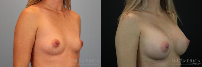 Before & After Breast Augmentation Case 152 View #4 View in Glen Carbon, IL