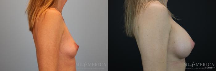 Before & After Breast Augmentation Case 152 View #5 View in Glen Carbon, IL