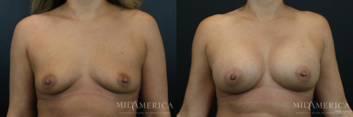 Before & After Breast Augmentation Case 178 View #1 View in St. Louis, MO