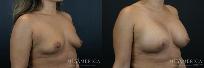 Before & After Breast Augmentation Case 178 View #4 View in St. Louis, MO