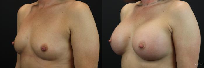 Before & After Breast Augmentation Case 196 Left Oblique View in St. Louis, MO