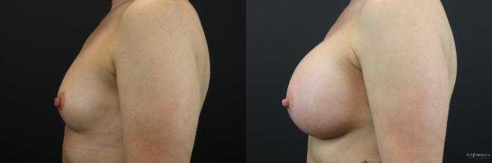 Before & After Breast Augmentation Case 196 Left Side View in St. Louis, MO