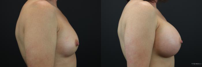 Before & After Breast Augmentation Case 196 Right Side View in St. Louis, MO