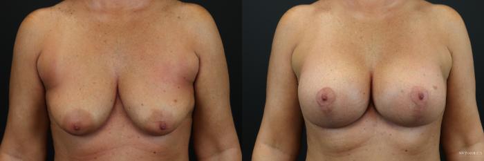 Before & After Breast Lift Case 198 Front View in Glen Carbon, IL