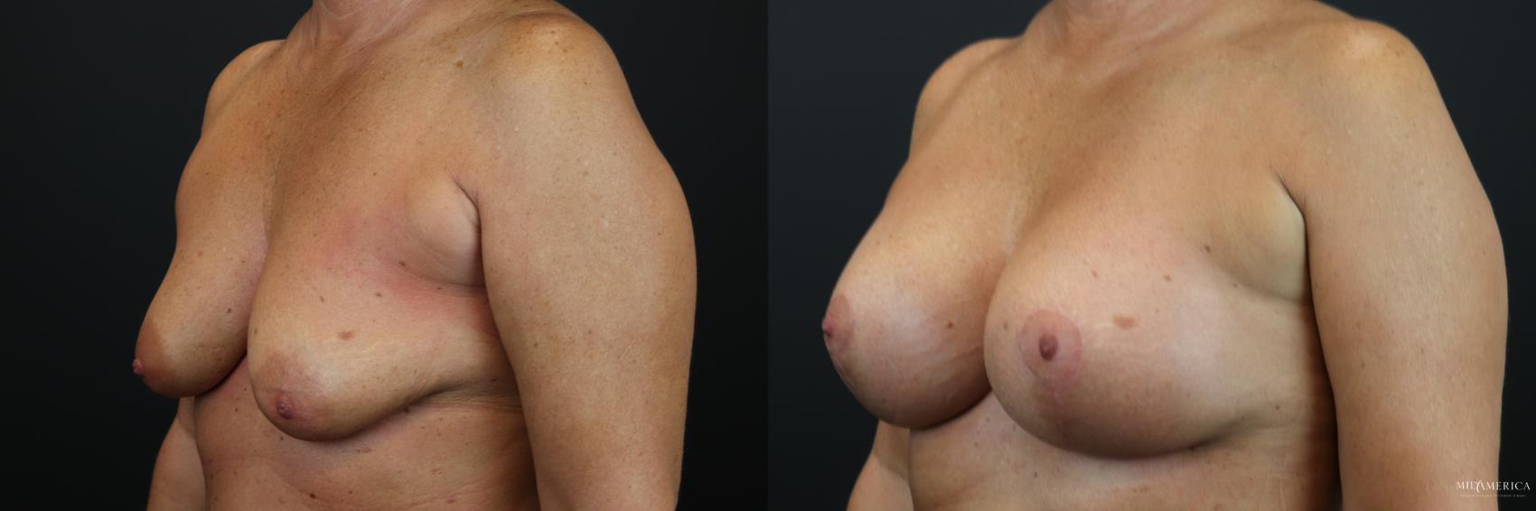 Before & After Breast Augmentation Case 198 Left Oblique View in Glen Carbon, IL