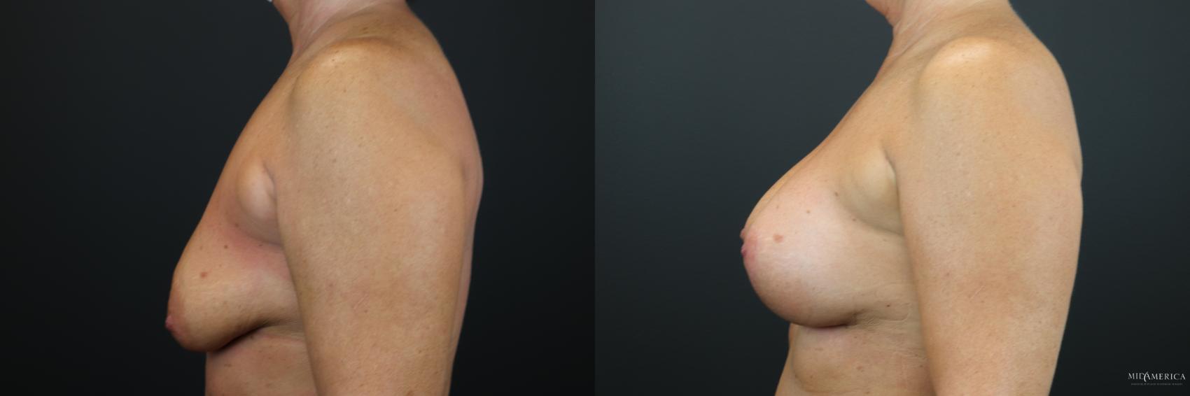 Before & After Breast Augmentation Case 198 Left Side View in Glen Carbon, IL