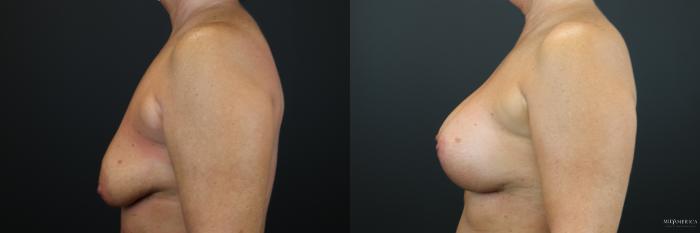 Before & After Breast Lift Case 198 Left Side View in St. Louis, MO