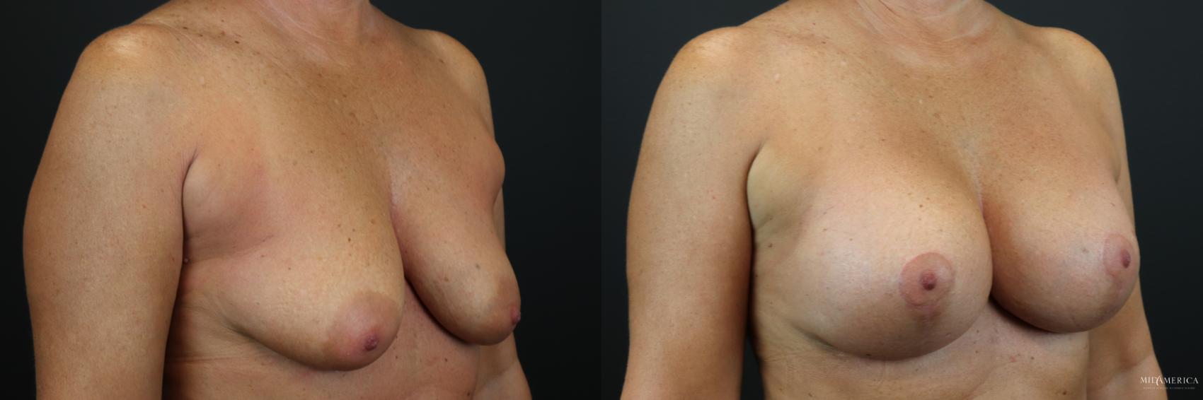 Before & After Breast Augmentation Case 198 Right Oblique View in Glen Carbon, IL