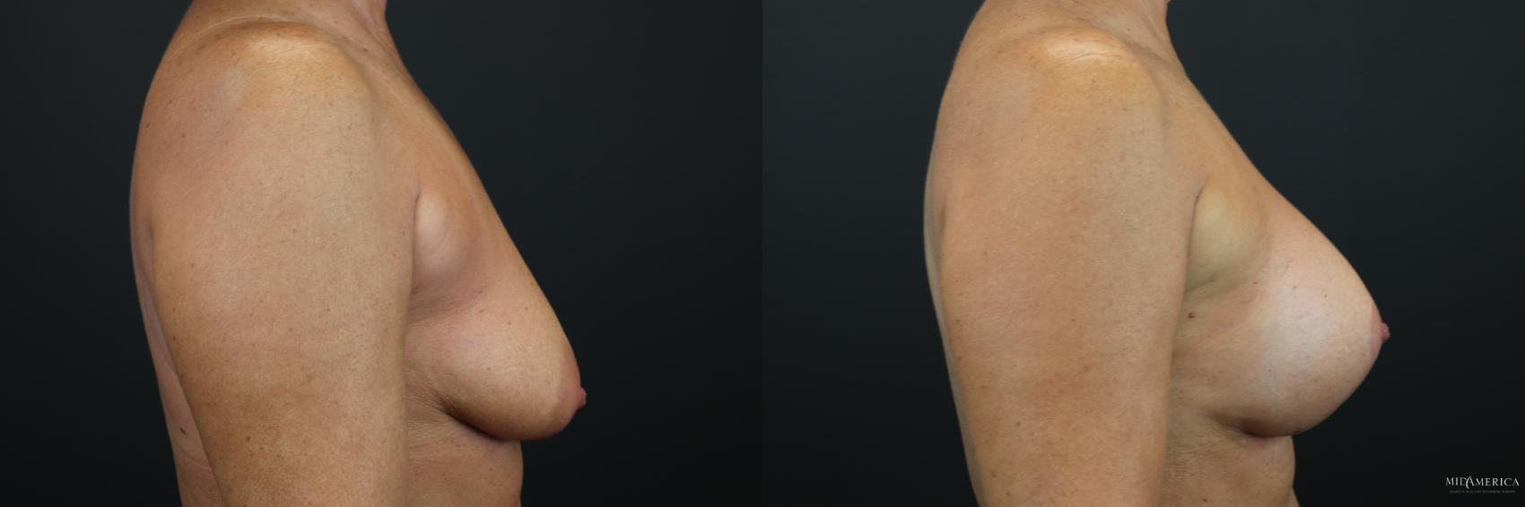 Before & After Breast Augmentation Case 198 Right Side View in Glen Carbon, IL