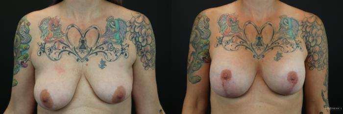 Before & After Breast Augmentation Case 202 Front View in St. Louis, MO