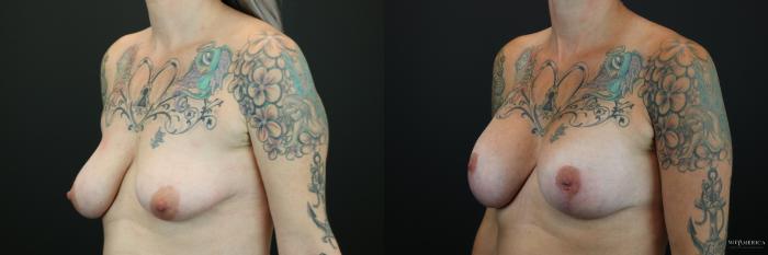 Before & After Breast Augmentation Case 202 Left Oblique View in St. Louis, MO