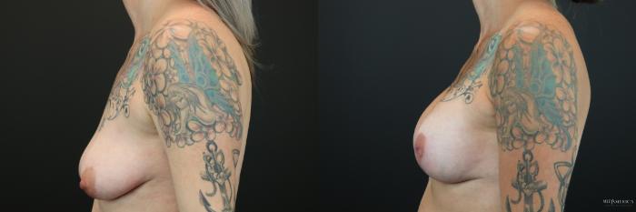 Before & After Breast Augmentation Case 202 Left Side View in St. Louis, MO