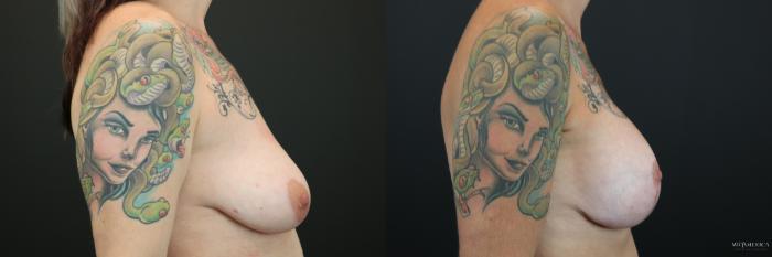 Before & After Breast Lift Case 202 Right Side View in St. Louis, MO