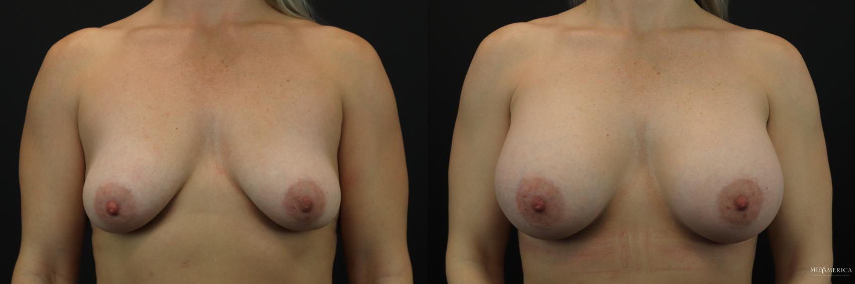 Before & After Breast Augmentation Case 211 Front View in Glen Carbon, IL