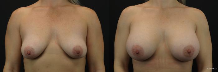 Before & After Breast Augmentation Case 211 Front View in Glen Carbon, IL
