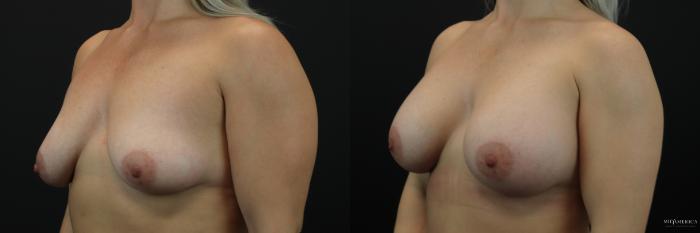 Before & After Breast Augmentation Case 211 Left Oblique View in Glen Carbon, IL