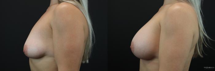 Before & After Breast Augmentation Case 211 Left Side View in Glen Carbon, IL