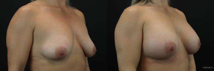 Before & After Breast Augmentation Case 211 Right Oblique View in Glen Carbon, IL