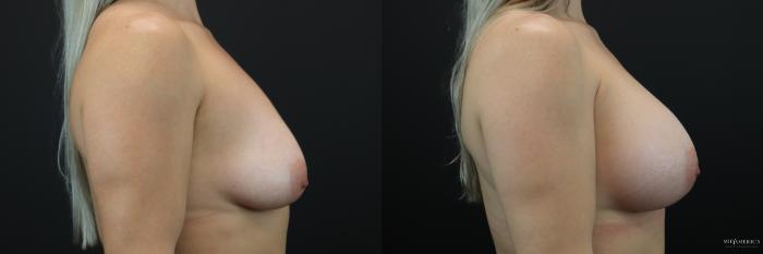 Before & After Breast Augmentation Case 211 Right Side View in Glen Carbon, IL