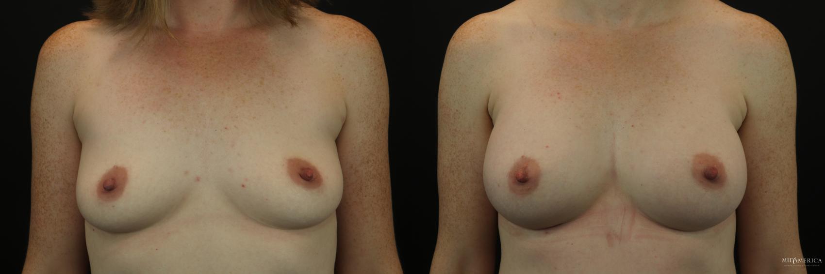 Before & After Breast Augmentation Case 213 Front View in Glen Carbon, IL